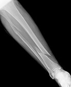 Fractured leg in osteoporosis,X-ray
