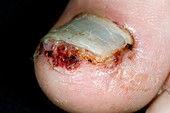 Damaged nail of stubbed toe
