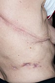 Surgical scars on the torso