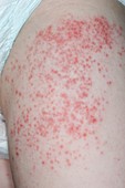 Lesions from hand,foot & mouth disease