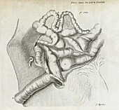 Fistula and hernia,18th century