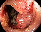 Rectal cancer,colonoscopic view