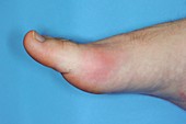Gout of the big toe