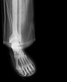Human foot,X-ray