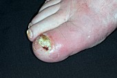 Cellulitis of the toe