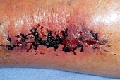 Infected wound after cancer removal