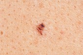 Mole (naevus) on the skin