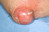 Bursitis of the elbow in gout