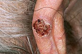 Basal cell (skin) cancer on the ear