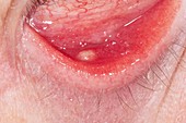 Meibomian cyst in the lower eyelid
