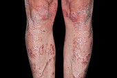 Plaque psoriasis on the legs