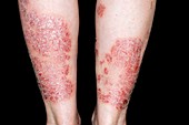 Plaque psoriasis on the legs