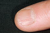 Abnormal fingernail in psoriasis