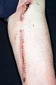 Surgical scar down the leg