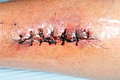 Wound after removal of cancer