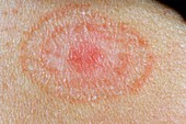 Ringworm (tinea) fungal skin infection