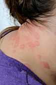 Urticaria on the neck