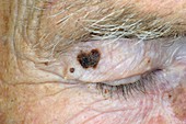 Pigmented hairy naevus on the eyelid