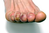 Raynaud's and chilblains of the toes