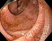 Duodenum in Whipples disease