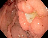 Ulcer in the stomach