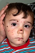 Impetigo skin infection in a child