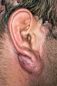 Dissecting folliculitis below the ear