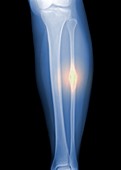 Bone cancer,X-ray