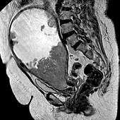 Cancer of the uterus,MRI scan