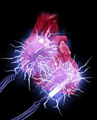 Defibrillator paddles shock the heart