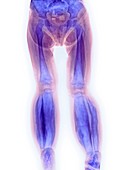 Caffey's disease,X-ray