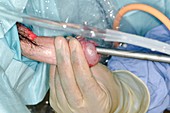 Male urethral dilation surgery