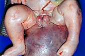 Congenital teratoma