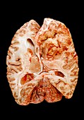 Brain cancer