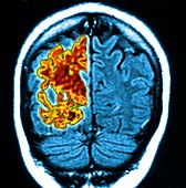 Alzheimer's brain,composite image