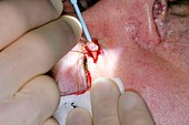 Excision of a basal cell skin cancer