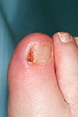 Infected ingrowing toenail