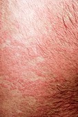 Urticaria rash on the back