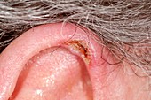 Chondrodermatitis nodule on the ear
