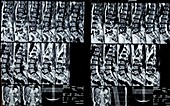 MRI scans of the spine