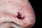 Basal cell skin cancer on the nose