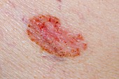 Basal cell skin cancer on the back