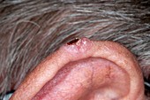 Basal cell skin cancer on the ear