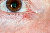 Basal cell skin cancer on eyelid