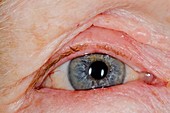 Blepharitis and eyelid eczema
