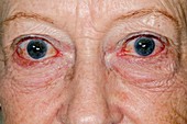 Bulging eyes in hyperthyroidism