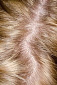 Psoriasis of the scalp