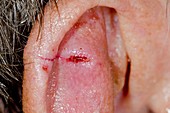 Cancer removal scar on the ear