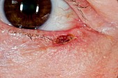 Cancer removal scar on the eyelid