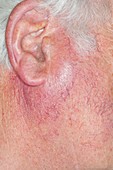 Parotid gland enlargement